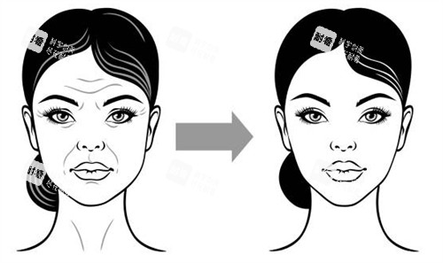 面部提升手術(shù)改善面部皺紋