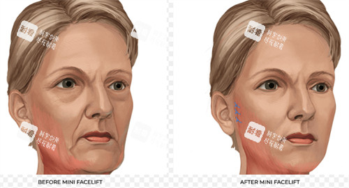 改善皮膚皺紋的面部提升