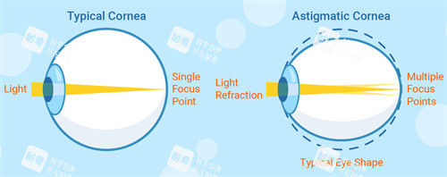 正常眼睛和散光眼睛成像不同