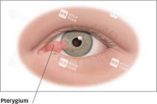 翼狀胬肉眼睛示意圖