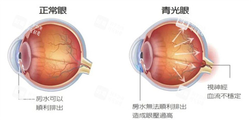 正常眼睛和青光眼的不同之處