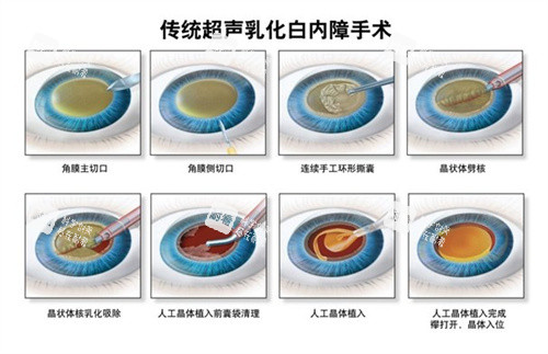 超聲乳化白內(nèi)障手術(shù)
