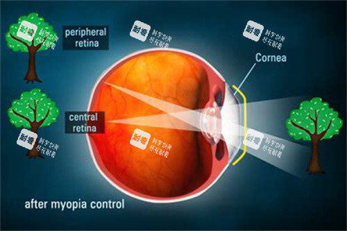 遠(yuǎn)視示意圖2