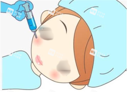 打針瘦臉手術過程圖