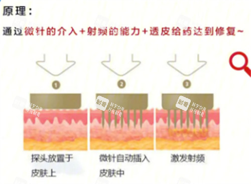 黃金微針原理分析