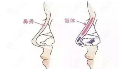 隆鼻手術(shù)示意圖