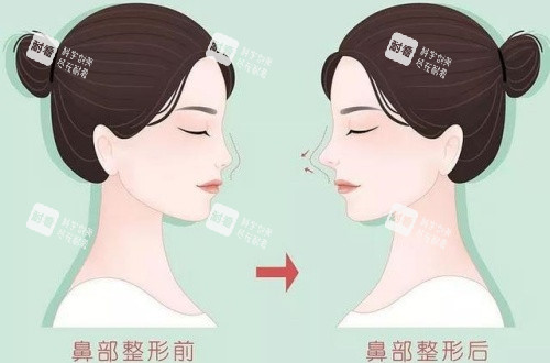 隆鼻術(shù)后漫畫示意圖