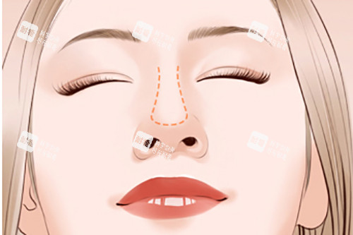 隆鼻鼻梁位置示意圖