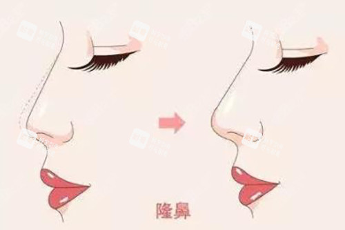 隆鼻對比示意圖