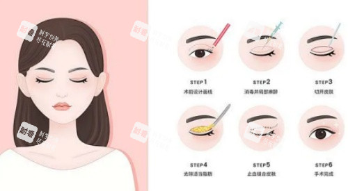 拉雙眼皮手術(shù)示意圖