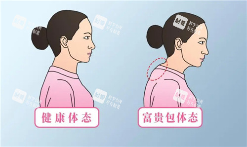 有無(wú)富貴包對(duì)比