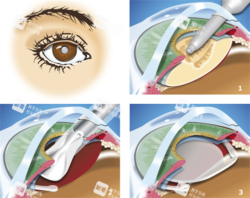 超聲乳化白內障吸除中