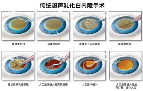 白內障超聲乳化手術流程圖