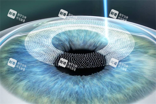 全飛秒手術動畫圖