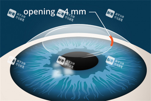 全飛秒手術動畫
