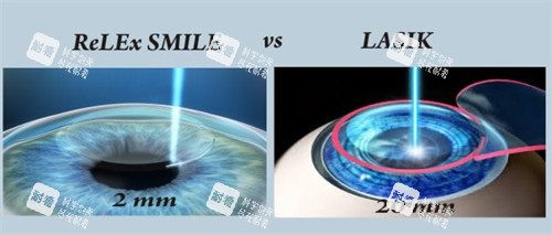 全飛秒近視手術帶來的切口圖解