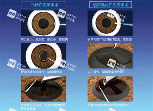 飛秒白內(nèi)障手術(shù)過程圖