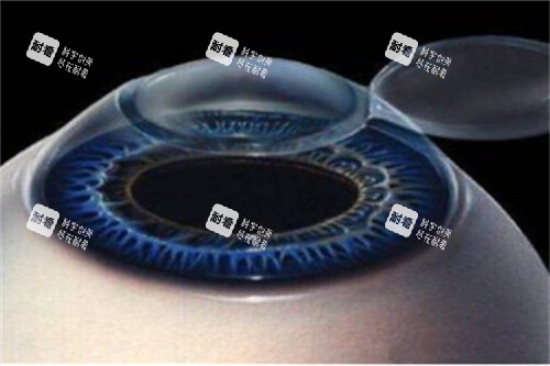 近視眼手術(shù)1