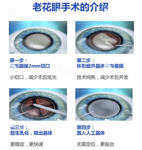 老花眼手術(shù)的介紹 老花眼手術(shù)的介紹