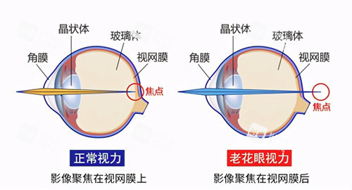 老花眼和正常視力 老花眼和正常視力