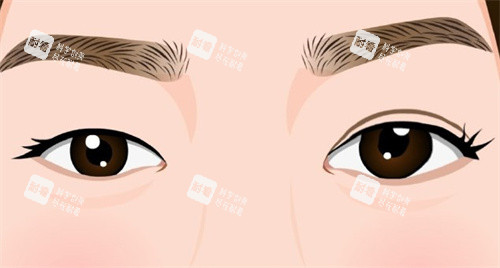 雙眼皮手術(shù)術(shù)前術(shù)后對(duì)比卡通