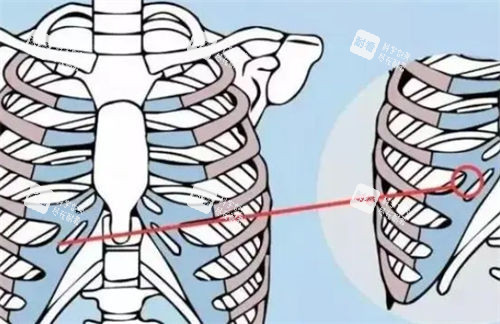 肋軟骨隆鼻肋部展示圖