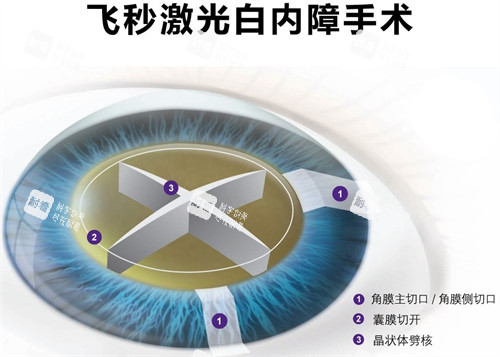 飛秒白內(nèi)障手術(shù)細(xì)節(jié)圖