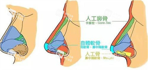 隆鼻手術(shù)對(duì)比