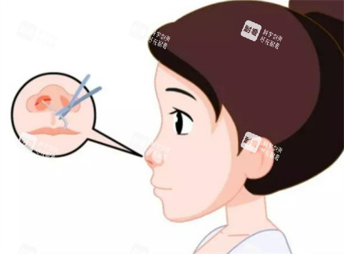 隆鼻切口的位置圖解