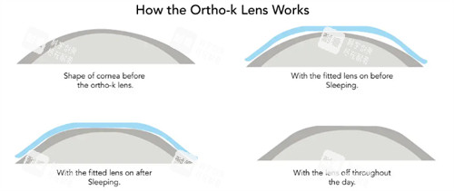角膜塑形鏡改善眼表