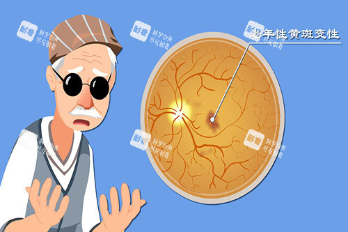 老年性黃斑病變卡通圖