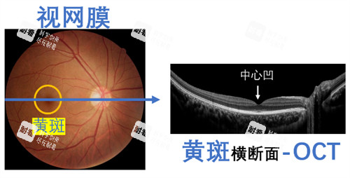 黃斑眼病橫切面的樣子圖解