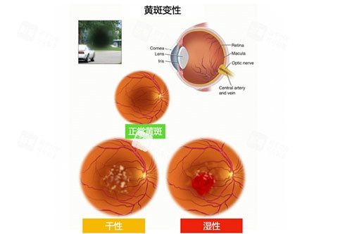 黃斑變性類別圖片