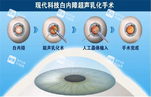 白內(nèi)障眼科手術(shù)過(guò)程