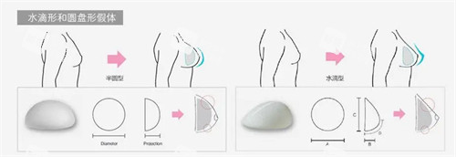 假體隆胸過程圖 假體隆胸過程圖