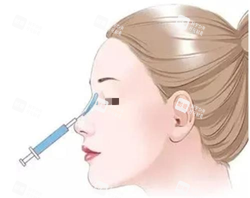 玻尿酸隆鼻示意圖