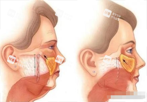 拉皮前后皮膚內(nèi)部以及表面變化圖