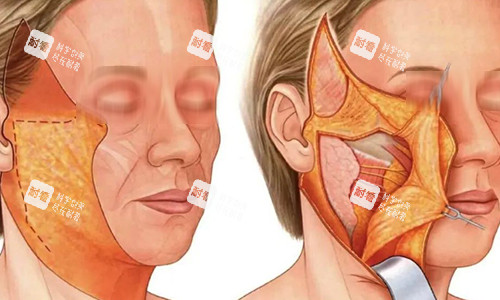 拉皮手術(shù)過程動(dòng)畫示意圖