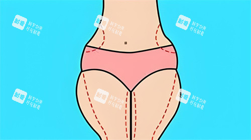 腿部吸脂手術吸脂部位動畫圖