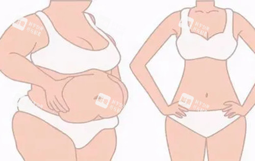 全身吸脂前后對比示意圖