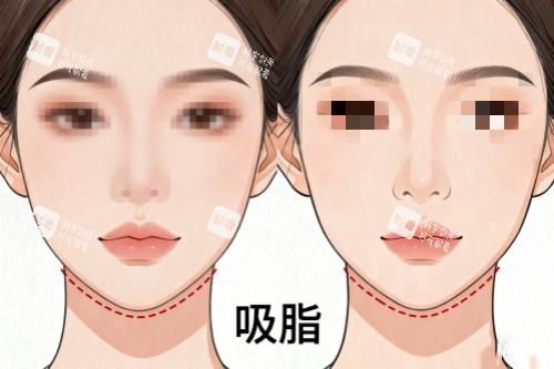 下巴做吸脂前后對比圖