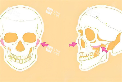顴骨手術磨骨部位骨頭演示動畫圖 顴骨手術磨骨部位骨頭演示動畫圖