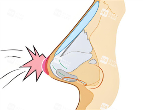隆鼻修復(fù)碰撞成因