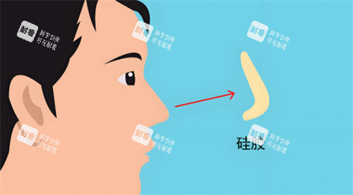 硅膠假體隆鼻 硅膠假體隆鼻