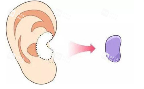 耳軟骨隆鼻移除位置展示圖 耳軟骨隆鼻移除位置展示圖