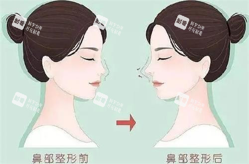 液態(tài)隆鼻前后的區(qū)別 液態(tài)隆鼻前后的區(qū)別