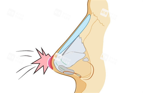 隆鼻假體鼻背動畫展示圖 隆鼻假體鼻背動畫展示圖