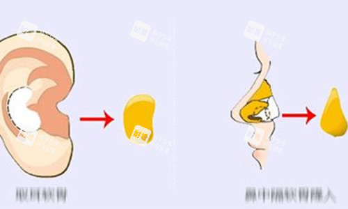 耳軟骨隆鼻動(dòng)畫示意圖