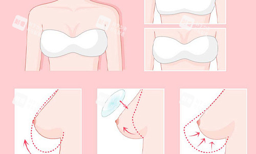 德國寶儷假體隆胸大揭秘！獨特優(yōu)勢、真實手感與術后驚艷結(jié)果全知曉