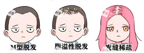 脫發(fā)種類(lèi)